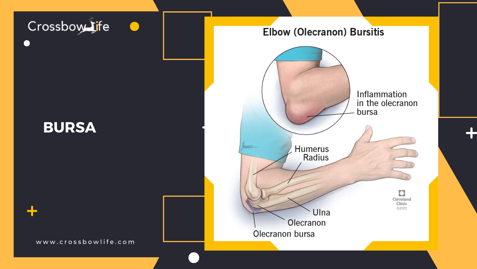 What are the injuries that archer’s usually faced? How to treat them?